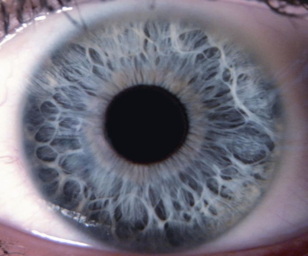 Podtyp osłabionej tkanki łącznej - niebieska tęczówka o bardzo osłabionej strukturze, z dużą liczbą zatok; beleczki są poplątane, sprawiają wrażenie chaosu. Pacjenci o takiej tęczówce mają bardzo duże problemy z odpornością.