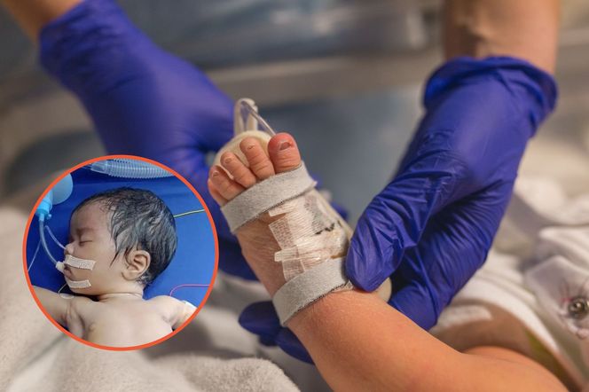 Noworodek miał spuchnięty brzuszek. Lekarze wykryli w nim 8 embrionów