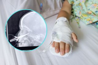 5-latka nadziała się na nożyczki podczas zabawy. Lekarze dokonali cudu