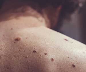 Powstał plaster na raka, niszczy komórki nowotworowe. Będzie przełom w leczeniu?