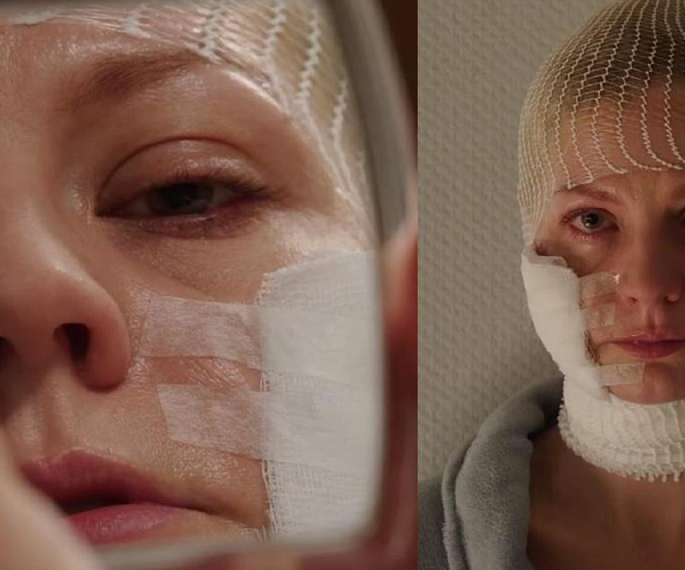 M jak miłość, odcinek 1767: Trauma Jagody oszpeconej bliznami! Nie zniesie tego, że wygląda jak potwór - ZDJĘCIA