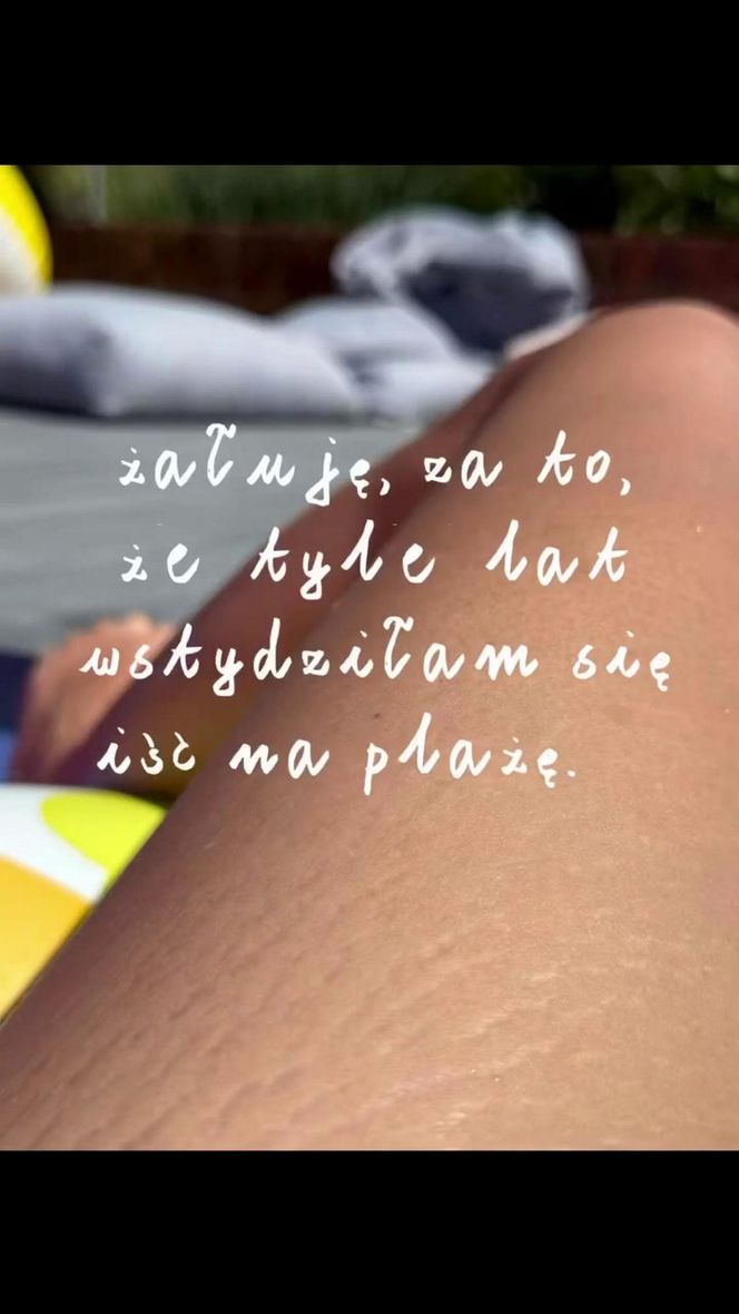 Dorota Szelągowska nie wstydzi się rozstępów