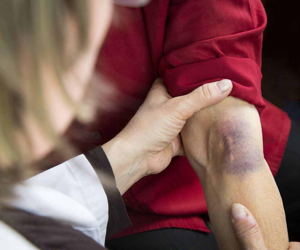 Siniak w zgięciu łokcia po pobieraniu krwi