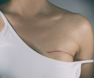 Zalecenia po mastektomii - co robić po zabiegu usunięcia piersi?