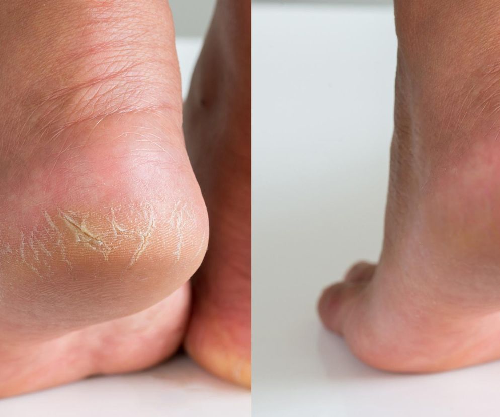 Sposób na pękające pięty