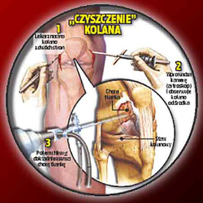 Czyszczenie kolana