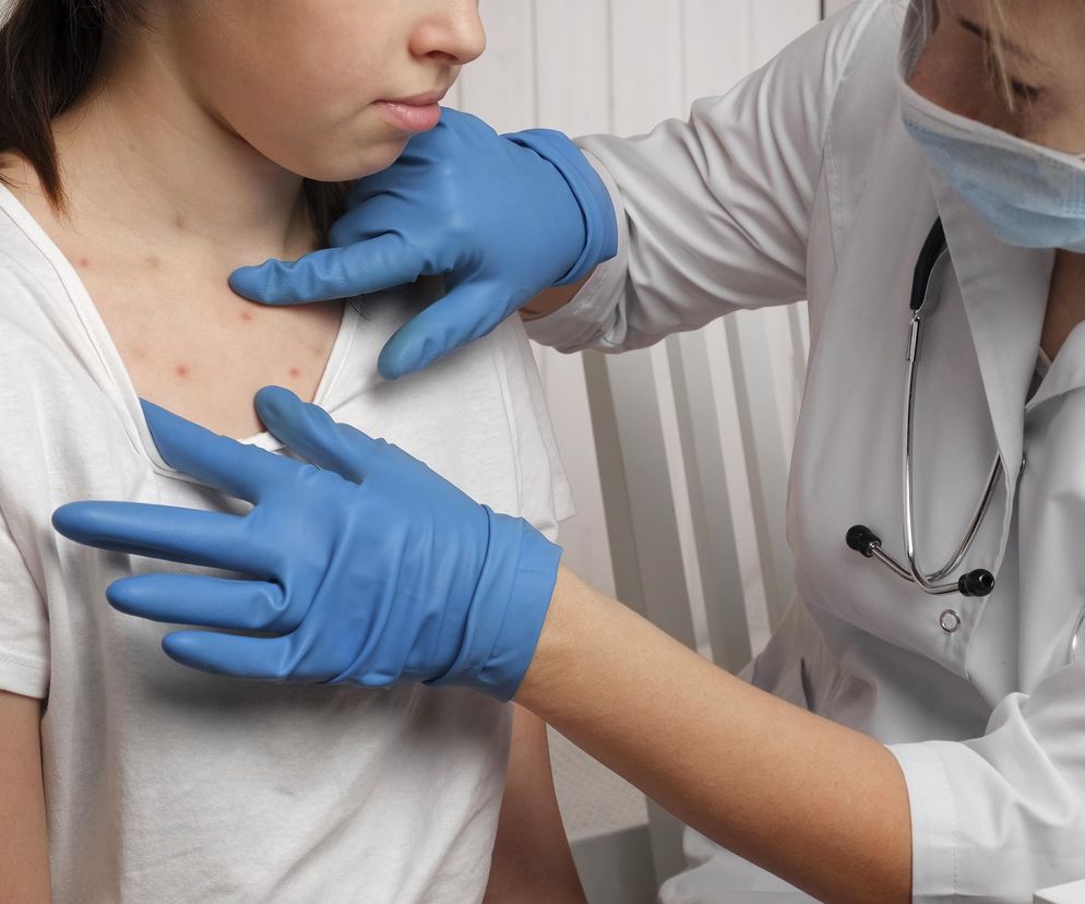 Nowy wariant mpox już przy polskiej granicy. Służby komentują