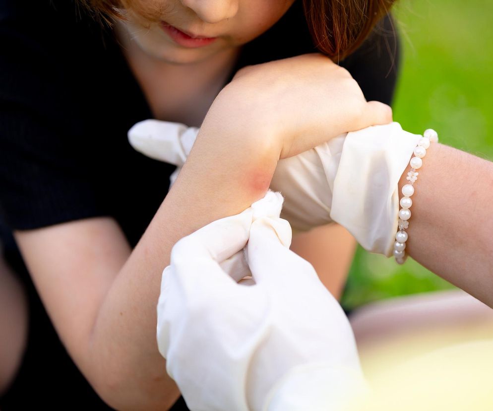 Jad owadów bywa zabójczy. Tak możesz sprawdzić, czy masz uczulenie 