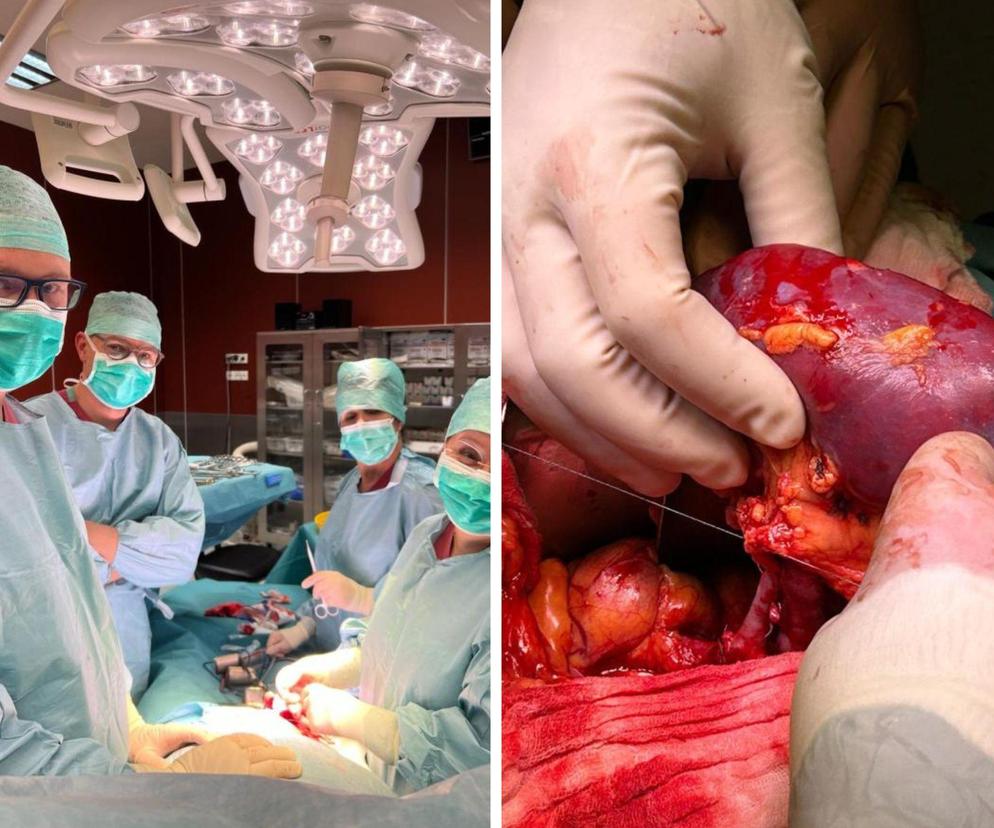 Jednoczasowy przeszczep serca i nerki w Śląskim Centrum Chorób Serca w Zabrzu 