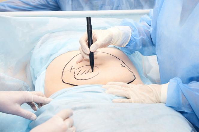 Histerektomia - na czym polega i kiedy wykonuje się chirurgiczne usunięcie macicy