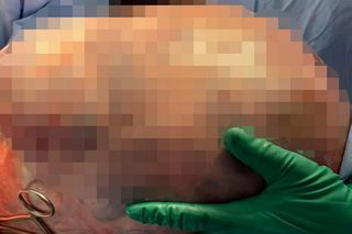 Ogromny guz jajnika usunięty w Centrum Onkologii w Bydgoszczy