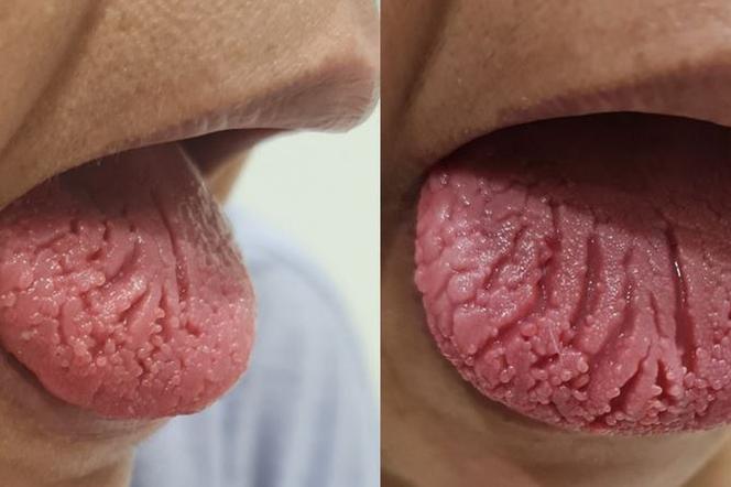 Zapalenie języka po szczepionce na COVID-19