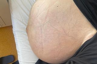 Lekarze ze szpitala Latawiec usunęli gigantycznego guza 38-letniej pacjentce