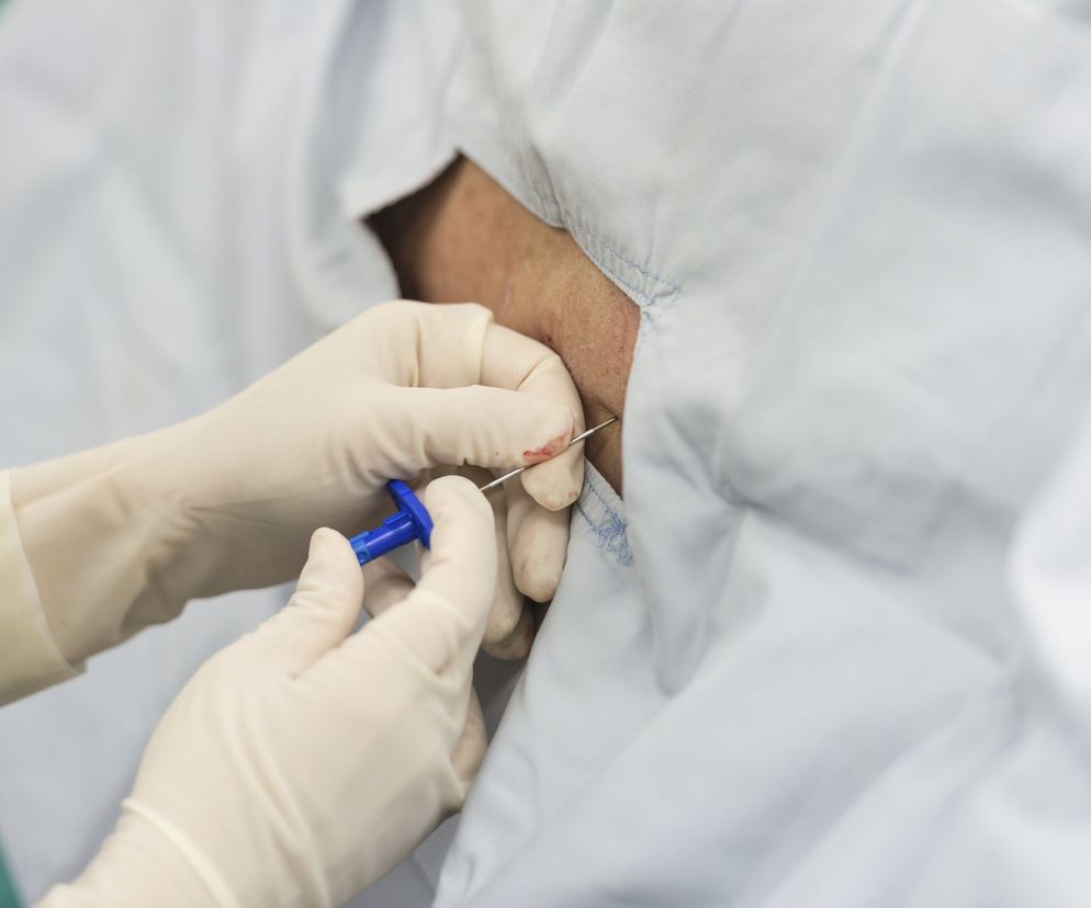 Punkcja kręgosłupa (lędźwiowa ) polega na wprowadzeniu igły punkcyjnej między kręgi kręgosłupa lędźwiowego.