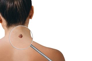Jakie zmiany skórne powinny nas zaniepokoić? Dermatolog wyjaśnia