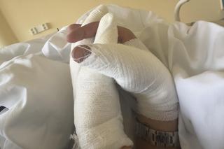 Koszmarny wypadek pięknej modelki. Jej twarz i ręce niemal spłonęły. Wieniawa apeluje o pomoc