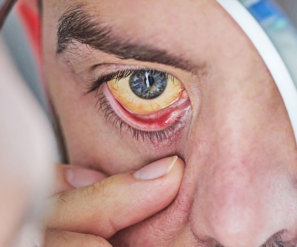 Lekarz wskazuje pierwsze objawy raka trzustki. Zauważysz je w... oczach