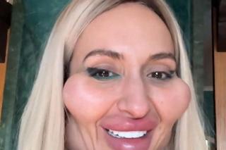 Ma największe policzki na świecie! I tak są za małe. Pokazała jak wyglądała kiedyś!