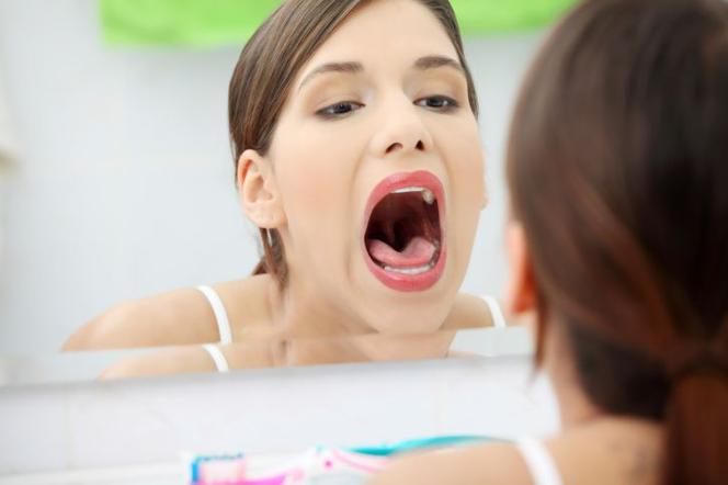 Pleśniawki u dorosłych: przyczyny i leczenie pleśniawek w jamie ustnej