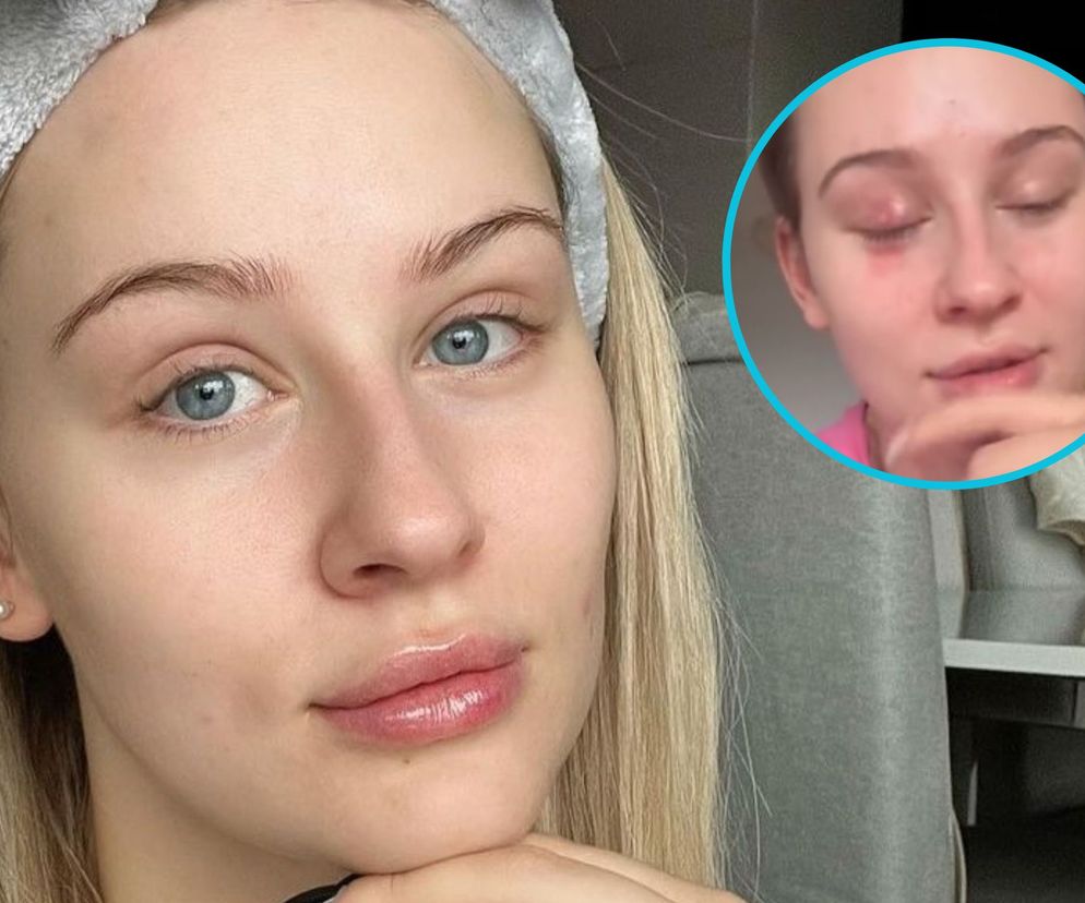 Polska influencerka chciała wyleczyć jęczmień domowy sposobem. Spaliłam sobie skórę