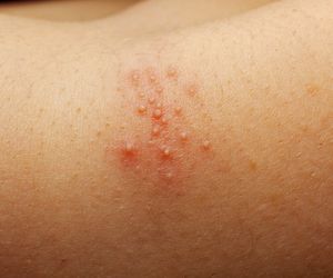 Potówki u dorosłych i dzieci - przyczyny i leczenie