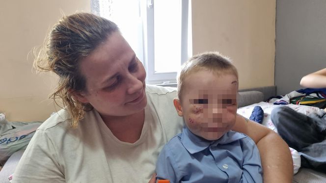 Pies pogryzł 3-latka na przystanku