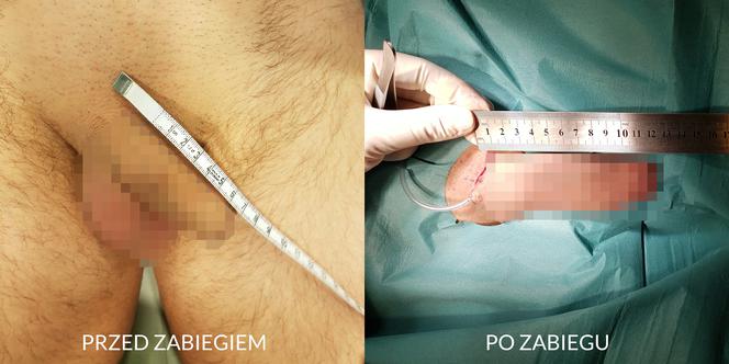 Chirurg ze Szczecina opracował nowatorską metodę wydłużania penisa