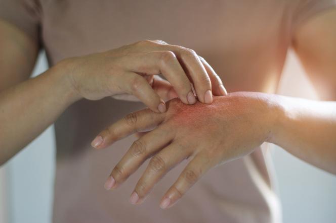 Egzema na dłoniach - przyczyny, objawy, leczenie