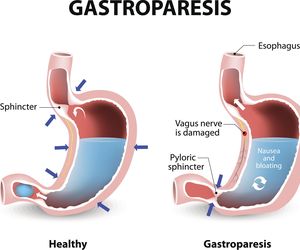 Gastropareza: przyczyny, objawy, leczenie