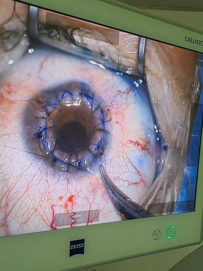 To pierwsza taka operacja na świecie. W Katowicach.