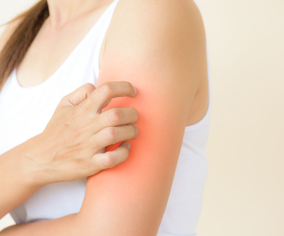 Dermografizm: przyczyny, objawy, leczenie pokrzywki dermograficznej