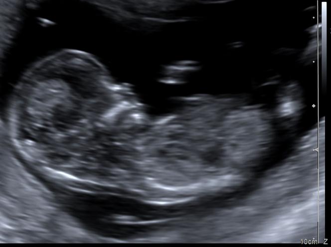 12 tydzień ciąży - USG