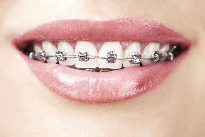Aparat ortodontyczny: rodzaje, zakładanie i higiena