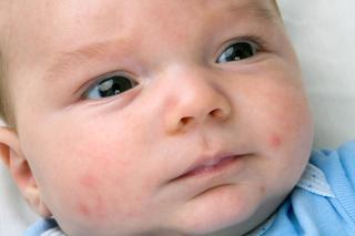 Wysypka u niemowlaka: potówki czy może alergia?