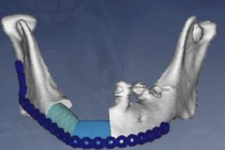 Z kości strzałkowej odtworzono żuchwę. Szpital w Zielonej górze mówi o unikalnej operacji [ZDJĘCIA]