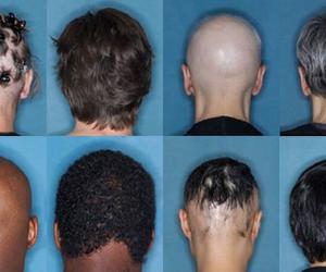 FDA zatwierdziła pierwszy skuteczny lek na łysienie. Pomoże milionom osób 