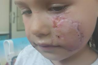 Amstaff rozszarpał buzię 4-letniej Nadii