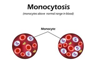 Monocytoza: przyczyny. Czy nadmiar monocytów jest groźny?