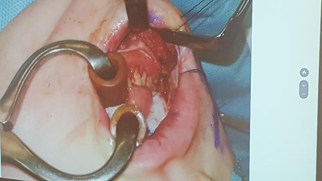 Gliwiccy lekarze dokonali kolejnego na światową skalę przeszczepu narządów szyi