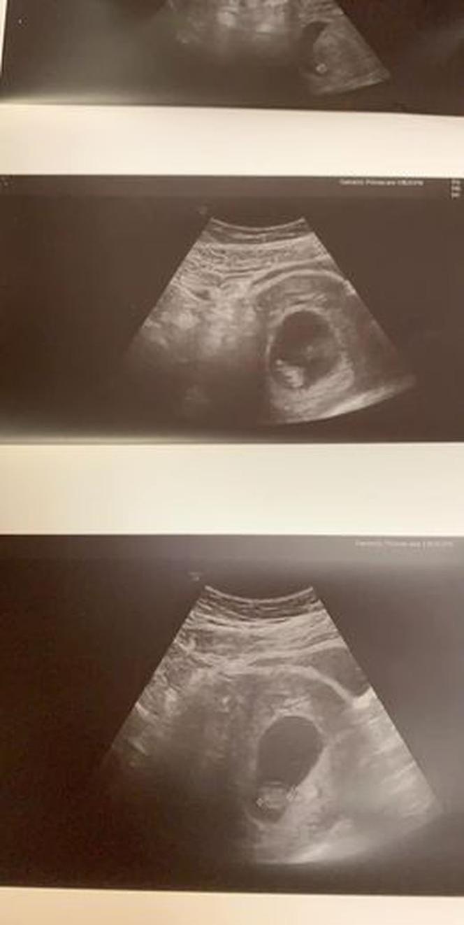 Wycięła dziecko z brzucha przyjaciółki! Matka i synek NIE ŻYJĄ