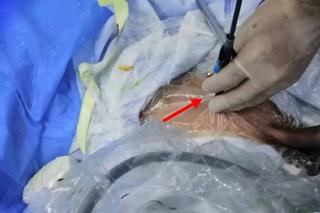 12-latek włożył sobie termometr do penisa. Szokująca zabawa erotyczna nastolatka