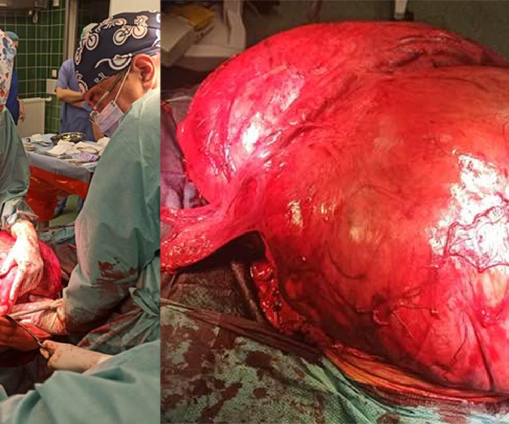 Lekarze z Zielonej Góry usunęli pacjentce 42-kilogramowy guz