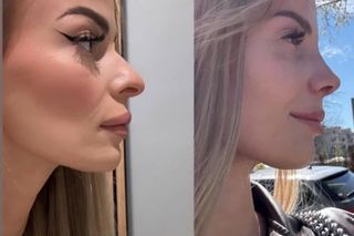 Dominika z Hotelu Paradise przeszła operację nosa. Pokazała efekty zabiegu