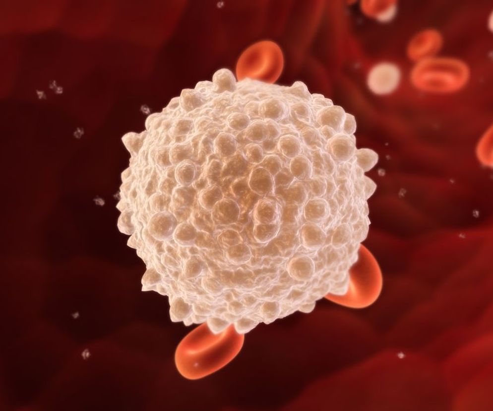 Makroglobulinemia Waldenströma to chłoniak limfoplazmocytowy, czyli nowotwór wywodzący się z układu chłonnego.