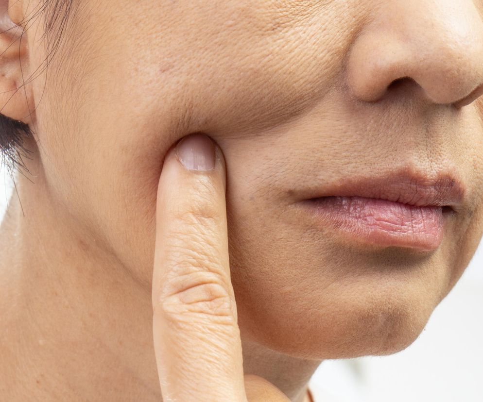 Sucha, napięta skóra? Sprawdź, czy nie bierzesz jednego z tych leków