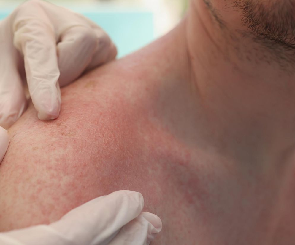 Wystarczy kilka słonecznych dni i przychodnie wypełniają się pacjentami z problemami skórnymi. Lekarka tłumaczy, co się dzieje