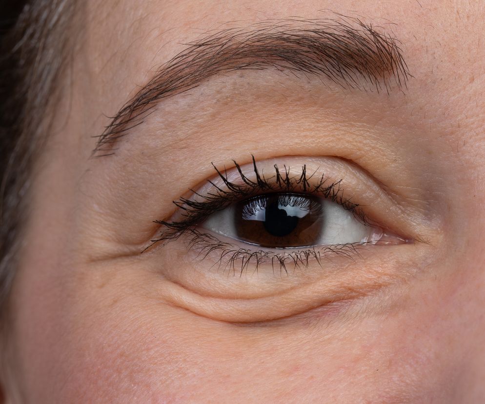 Łysienie, bóle stawów i opuchnięte powieki. To oznaki nadmiaru tej witaminy