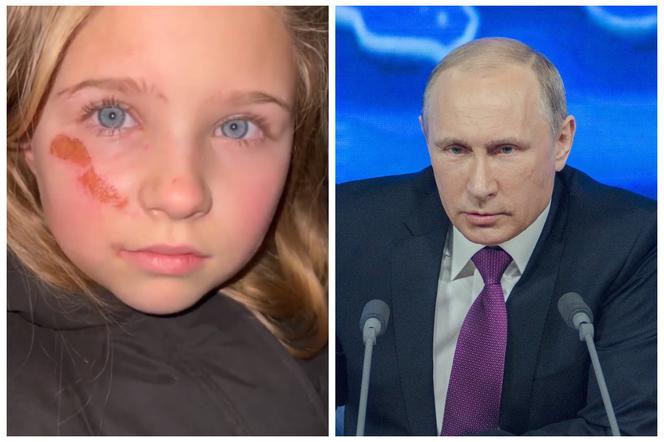 Ranna ukraińska dziewczyna apeluje do Putina! Poruszające nagranie obiegło sieć [WIDEO]
