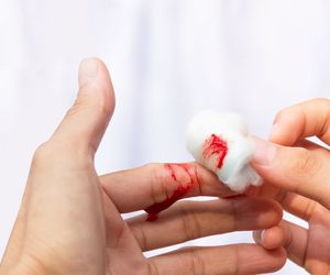Hemostaza - przebieg. Zaburzenia hemostazy