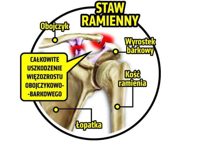 Kamil Glik, kontuzja, infografika